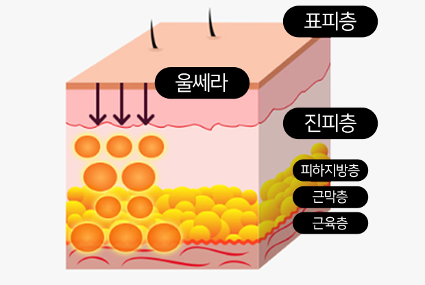 超声刀作用层次示意